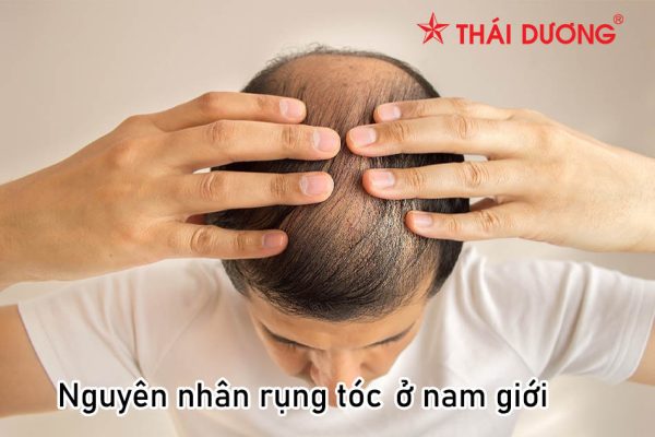 Nguyên nhân gây rụng tóc ở nam giới