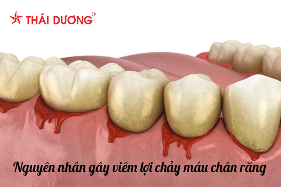 Chảy máu chân răng thiếu chất gì?