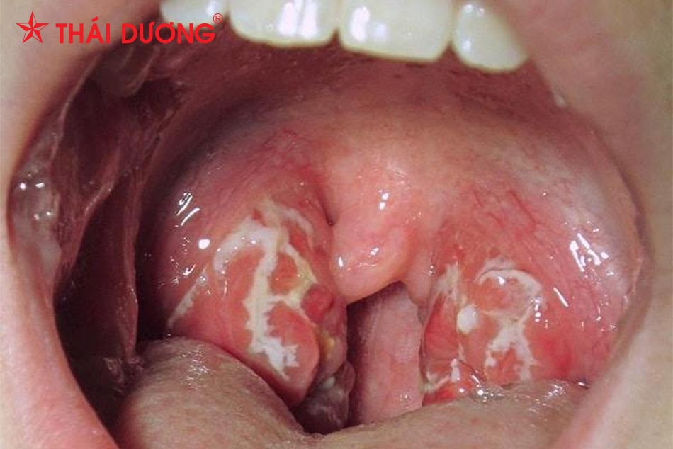 Viêm họng hạt là một bệnh nhiễm trùng do vi khuẩn, không phải vi rút gây ra, gây ra hơi thở có mùi