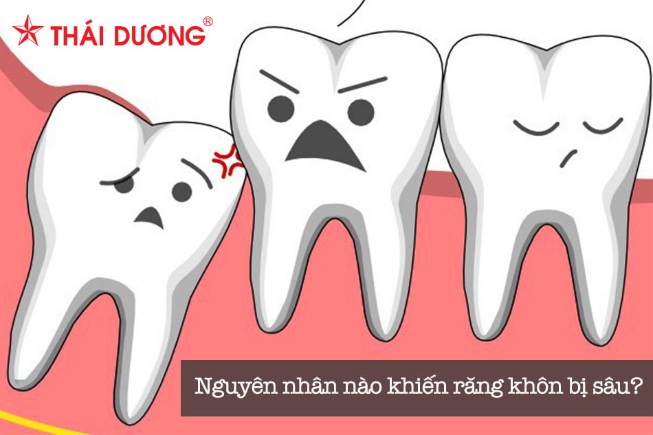Nguyên nhân răng khôn bị sâu