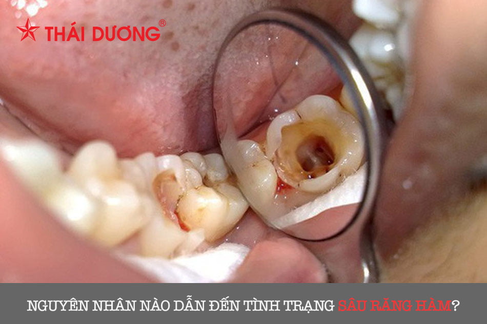 Nguyên nhân nào dẫn đến tình trạng sâu răng hàm?